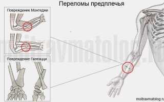 Перелом руки какая степень тяжести вреда здоровью