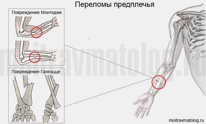 Перелом руки какая степень тяжести вреда здоровью Перелом руки какая степень тяжести вреда здоровью